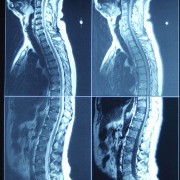 Herniated Disc related image